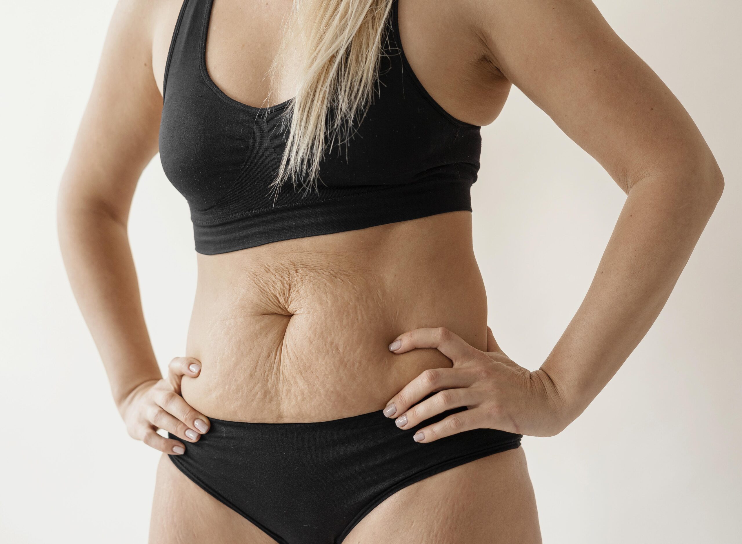 Best Stretch Marks Cream